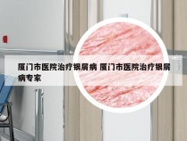 厦门市医院治疗银屑病 厦门市医院治疗银屑病专家