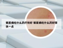 银屑病吃什么药疗效好 银屑病吃什么药好得快一点