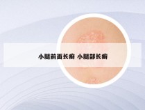 小腿前面长癣 小腿部长癣