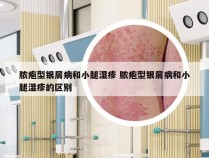 脓疱型银屑病和小腿湿疹 脓疱型银屑病和小腿湿疹的区别