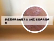 脓疱型银屑病的并发症 脓疱型银屑病病因病机