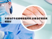 长春治疗牛皮癣哪些医院好 长春治疗银屑病哪里好