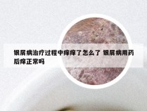 银屑病治疗过程中痒痒了怎么了 银屑病用药后痒正常吗