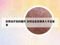 白斑治疗后的图片 白斑治愈后很多人不在复发