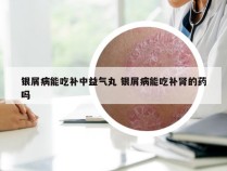 银屑病能吃补中益气丸 银屑病能吃补肾的药吗