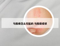 勾股癣怎么引起的 勾股藓症状