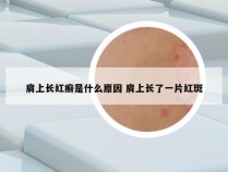 肩上长红癣是什么原因 肩上长了一片红斑