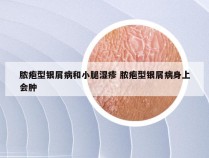 脓疱型银屑病和小腿湿疹 脓疱型银屑病身上会肿