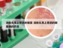 消除头发上得到的银屑 消除头发上得到的银屑病的药膏