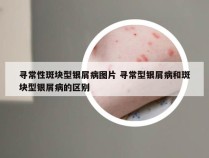 寻常性斑块型银屑病图片 寻常型银屑病和斑块型银屑病的区别