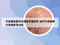 牛皮癣患者可以使用青霉素吗 治疗牛皮肤癣打青霉素可以吗