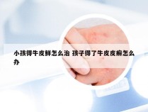 小孩得牛皮鲜怎么治 孩子得了牛皮皮癣怎么办