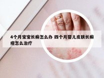 4个月宝宝长癣怎么办 四个月婴儿皮肤长癣疮怎么治疗