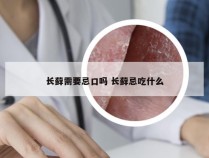 长藓需要忌口吗 长藓忌吃什么