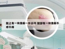 腿上有一块像癣一样会印 腿部有一块像癣不疼不痒