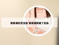 银屑病扣完流血 银屑病抓破了出血