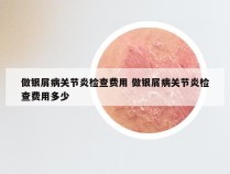 做银屑病关节炎检查费用 做银屑病关节炎检查费用多少