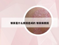 银屑是什么原因造成的 银屑癣原因