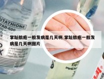 掌趾脓疱一般发病是几天啊 掌趾脓疱一般发病是几天啊图片