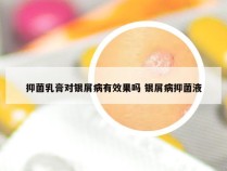 抑菌乳膏对银屑病有效果吗 银屑病抑菌液