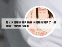 老公大腿根内侧长癣癣 大腿根内侧长了一些像癣一样的会传染吗