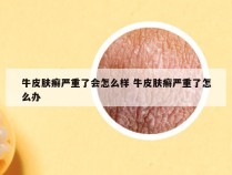 牛皮肤癣严重了会怎么样 牛皮肤癣严重了怎么办