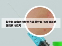 长春银屑病医院检查方法是什么 长春银屑病医院预约挂号