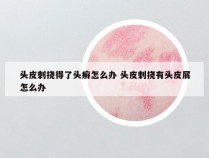 头皮刺挠得了头癣怎么办 头皮刺挠有头皮屑怎么办