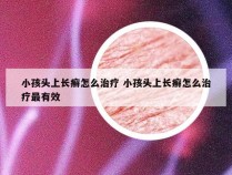 小孩头上长癣怎么治疗 小孩头上长癣怎么治疗最有效