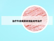 治疗牛皮癣激素烧起皮咋治疗