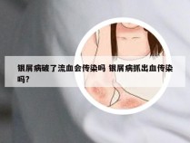 银屑病破了流血会传染吗 银屑病抓出血传染吗?