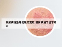 银屑病消退环出现又变红 银屑病消了留下红印