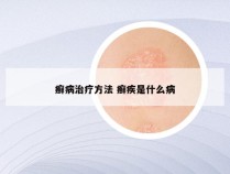 癣病治疗方法 癣疾是什么病