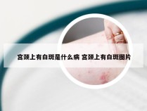 宫颈上有白斑是什么病 宫颈上有白斑图片