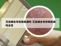 艾滋病会导致银屑病吗 艾滋病会导致银屑病吗女性