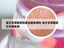 复方甘草酸苷胶囊治银屑病吗 复方甘草酸苷片对银屑病