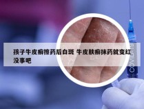 孩子牛皮癣擦药后白斑 牛皮肤癣抹药就变红没事吧