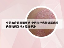 中药治疗头部银屑病 中药治疗头部银屑病后头发粘稠怎样才能洗干净