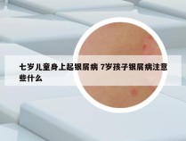 七岁儿童身上起银屑病 7岁孩子银屑病注意些什么