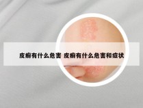 皮癣有什么危害 皮癣有什么危害和症状