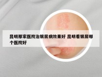 昆明那家医院治银屑病效果好 昆明看银屑哪个医院好