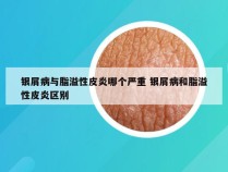 银屑病与脂溢性皮炎哪个严重 银屑病和脂溢性皮炎区别