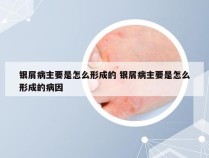 银屑病主要是怎么形成的 银屑病主要是怎么形成的病因