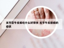 关节型牛皮癣吃什么好得快 关节牛皮肤癣的症状