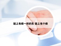 腿上有癣一样的东 腿上有个癣