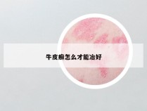 牛皮癣怎么才能冶好