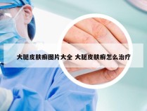 大腿皮肤癣图片大全 大腿皮肤癣怎么治疗