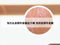 为什么会得牛皮癣这个病 为何会得牛皮廨