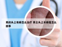 男的头上有癣怎么治疗 男士头上长癣是怎么回事