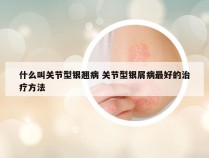 什么叫关节型银翘病 关节型银屑病最好的治疗方法